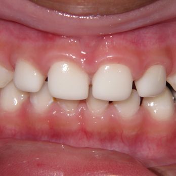 Suzanne Clift, DDS - Early childhood caries restored with Zirconia (white) crowns. - Pediatric Dentists Near Me - Vallejo, California Suzanne Clift, DDS - Early childhood caries restored with Zirconia (white) crowns. - Pediatric Dentists Near Me - Vallejo, California