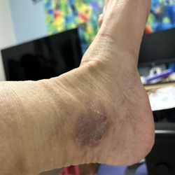 South Orange County Surgical Medical Group - OC Surgeons - The oozing wound