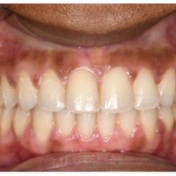 Old Bridge Orthodontics - After results