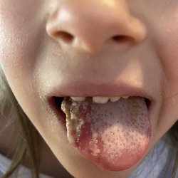 Wash Park Pediatric Dentistry - This was after 4 to 5 days!!! She couldn't speak properly for almost 2 weeks and couldn't eat regular foods for over a week!