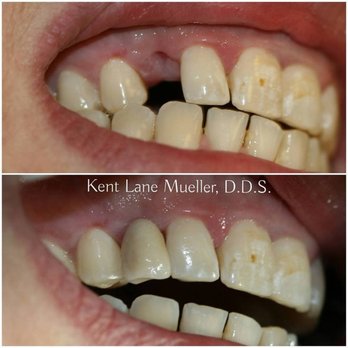 Kent Lane Mueller, DDS - Maryland Bridge - General Dentistry Near Me - Willow Grove, Pennsylvania