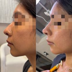 Haus Of Aphrodite - Non surgical rhinoplasty