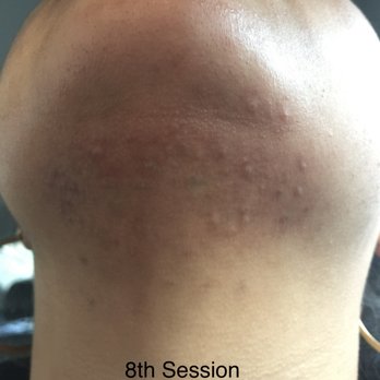 Laser Remedy MedSpa - 8th Session - Laser Hair Removal Near Me - Philadelphia, Pennsylvania Laser Remedy MedSpa - 8th Session - Laser Hair Removal Near Me - Philadelphia, Pennsylvania
