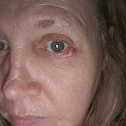 Clay Eye Physicians & Surgeons - And THIS is *nothing to worry about*   nearly 3 weeks of agony.