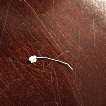 Yim Orthodontics - A picture of the glue still fully attached to the problem side of my retainer. - Orthodontists Near Me - Kailua Kona, Hawaii Yim Orthodontics - A picture of the glue still fully attached to the problem side of my retainer. - Orthodontists Near Me - Kailua Kona, Hawaii