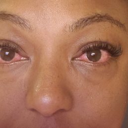 Pinkeye from lashes done at Flawless lashes by Amy Pinkeye from lashes done at Flawless lashes by Amy