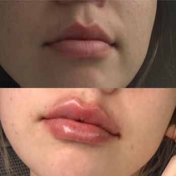 Ageless MD - Before and after - Medical Spas Near Me - Tustin, California Ageless MD - Before and after - Medical Spas Near Me - Tustin, California