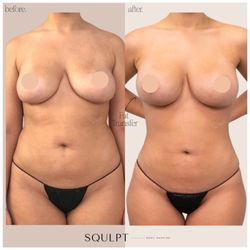 Squlpt Body Shaping - Fat Transfer Breasts (Silicone Free Zone™, 800 cc/side) + SoftSqulpt™ awake liposuction to abdomen, waist & hips, back bra roll, lower back