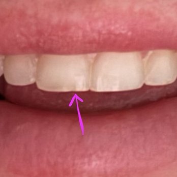 Ideal Dental Denton - The front piece of my tooth that was fill by my previous dentist lasting 3 years! Only lasted 3 days with this dentist! - General Dentistry Near Me - Denton, Texas Ideal Dental Denton - The front piece of my tooth that was fill by my previous dentist lasting 3 years! Only lasted 3 days with this dentist! - General Dentistry Near Me - Denton, Texas
