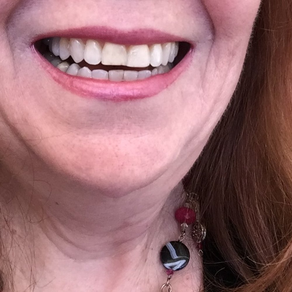 Cohen Orthodontics - On the way to my "rockstar" smile. LOL. - Orthodontists Near Me - Dunwoody, Georgia Cohen Orthodontics - On the way to my "rockstar" smile. LOL. - Orthodontists Near Me - Dunwoody, Georgia