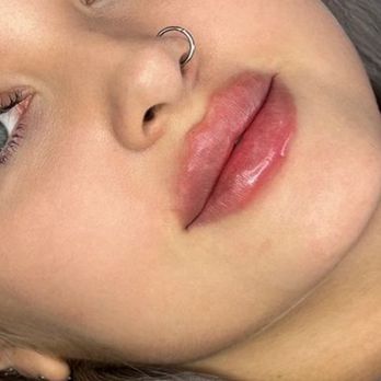 Botox & Beyond Med Spa - Russian Lips technique
Dermal Filler - Medical Spas Near Me - San Diego, California Botox & Beyond Med Spa - Russian Lips technique
Dermal Filler - Medical Spas Near Me - San Diego, California