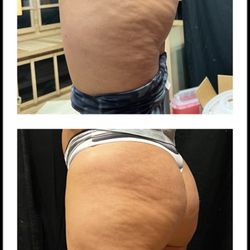 Lotus Skin Care Center - Microneedle RF after 2 sessions for the reduction of cellulite and stretch marks