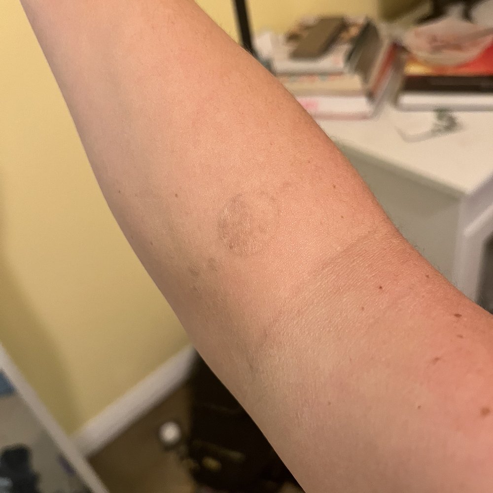 LaserAway - Tattoo 2023 - Laser Hair Removal Near Me - Carlsbad, California