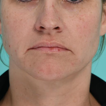 Jacob Sedgh, MD - front profile - before septorhinoplasty and lip lift - Cosmetic Surgeons Near Me - West Hollywood, California Jacob Sedgh, MD - front profile - before septorhinoplasty and lip lift - Cosmetic Surgeons Near Me - West Hollywood, California