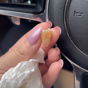 Lemoncreek Dental - Extraction wisdom teeth. - Cosmetic Dentists Near Me - Walnut, California Lemoncreek Dental - Extraction wisdom teeth. - Cosmetic Dentists Near Me - Walnut, California