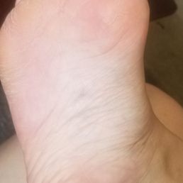 Pedicure results Pedicure results