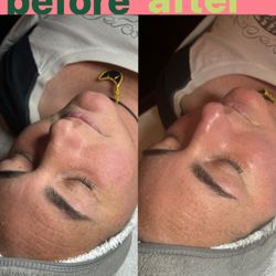 Before and After Glow Facial