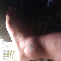 Bug bites from last night. My whole ankle is swollen now!!! Bug bites from last night. My whole ankle is swollen now!!!