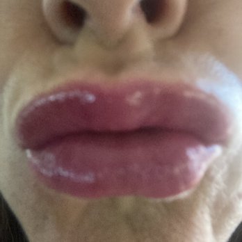 Renee Patel, MD - Day three after 1.2 ml of Restylane lip filler in both upper and lower lip.  Light makeup applied.  Cupid's bow was enhanced. - Laser Hair Removal Near Me - Downey, California