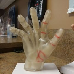 Southland Arthritis - Model of a hand with joint inflammation