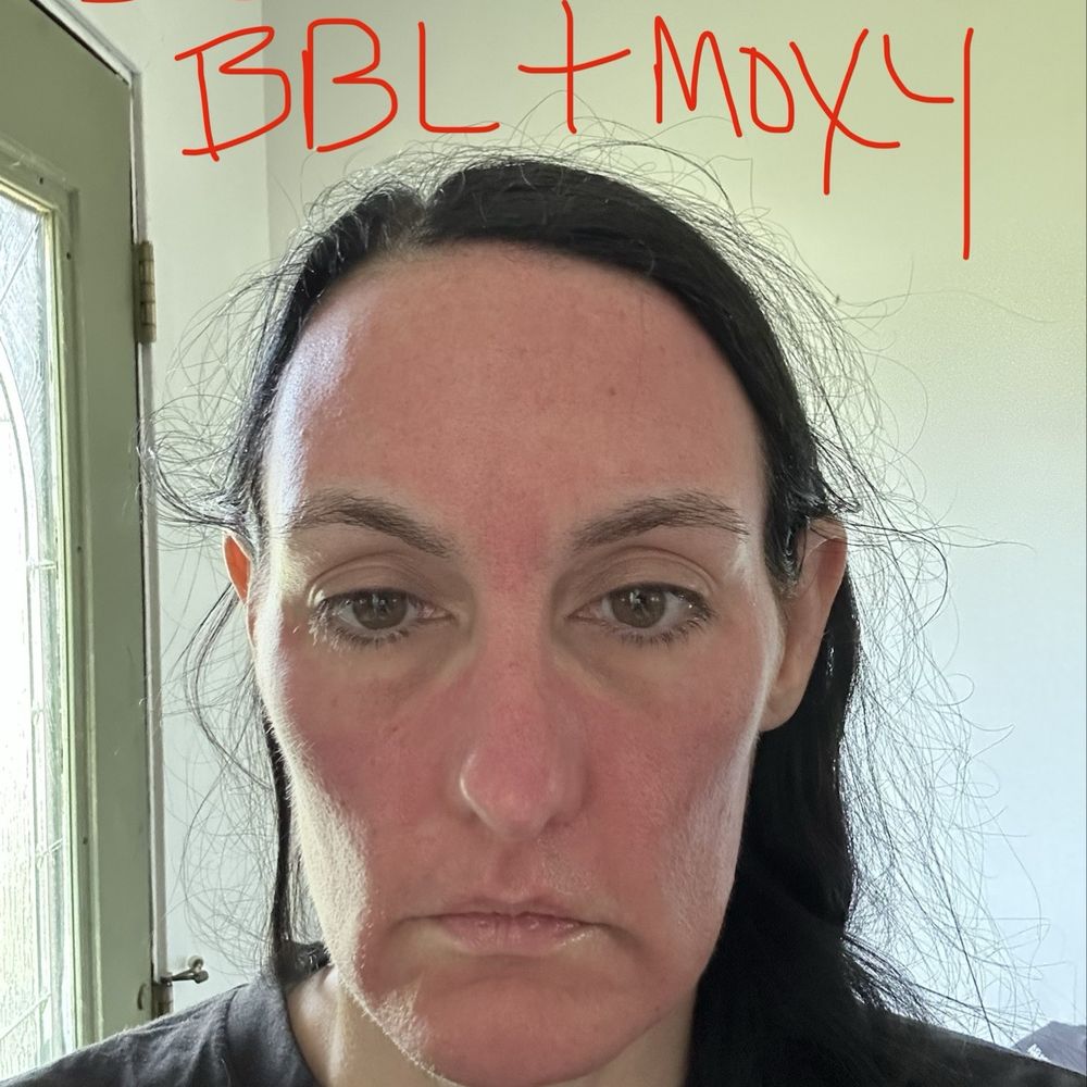 Turkle & Associates - 30 minutes after first treatment of both Moxy & BBL laser same day! - Cosmetic Surgeons Near Me - Carmel, Indiana