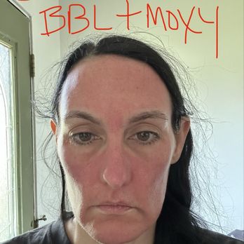 Turkle & Associates - 30 minutes after first treatment of both Moxy & BBL laser same day! - Cosmetic Surgeons Near Me - Carmel, Indiana