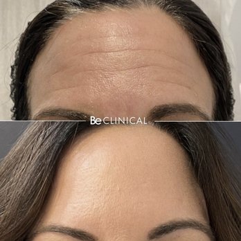Be Clinical - Botox for Forehead Lines - Skin Care Near Me - San Ramon, California