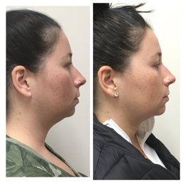 Chin filler by Emily Findley