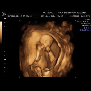 First Look Ultrasound - A 4D pic of baby boy sucking his thumb. - Diagnostic Imaging Near Me - Kaneohe, Hawaii