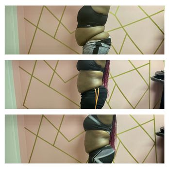 Silhouette Body Contouring - Medical Spas Near Me - Bedford, Ohio Silhouette Body Contouring - Medical Spas Near Me - Bedford, Ohio
