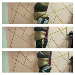 Silhouette Body Contouring