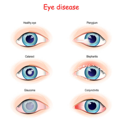 Various Eye diseases