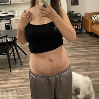 Lisa Hwang, MD - Before Tummy Tuck - Plastic Surgeons Near Me - Campbell, California Lisa Hwang, MD - Before Tummy Tuck - Plastic Surgeons Near Me - Campbell, California