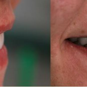 The Prosthodontic Center - Full mouth rehab - Prosthodontists Near Me - Beverly Hills, California The Prosthodontic Center - Full mouth rehab - Prosthodontists Near Me - Beverly Hills, California
