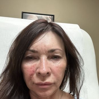 Ideal Image Summerlin - The next day - Laser Hair Removal Near Me - Las Vegas, Nevada Ideal Image Summerlin - The next day - Laser Hair Removal Near Me - Las Vegas, Nevada