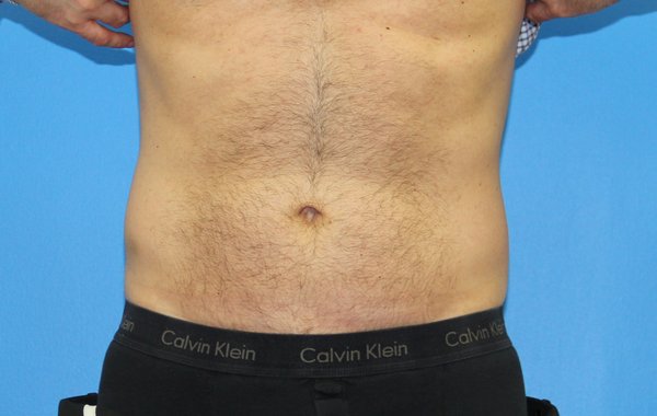 Dr Joseph Michaels Plastic Surgeon Reviews JOSEPH MICHAELS, MD,FACS - Updated June 2025 - 10 Photos & 33 Reviews