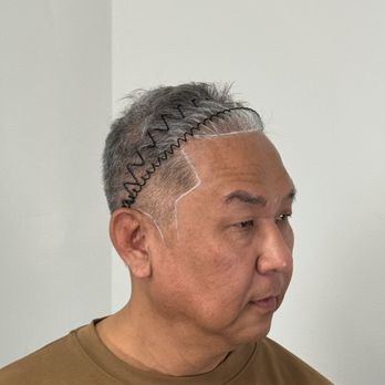 Chuldu Scalp Micropigmentation - Before and after - Hair Loss Centers Near Me - Los Angeles, California