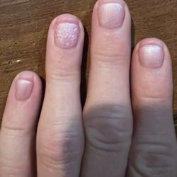 Nails cut back to the nail bed and with irritated sore puffy skin coming up over the nail at the end day one