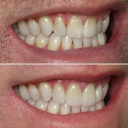 Bidwell Dental - 4 veneers to enhance this patient's smile completed by Dr. Rob