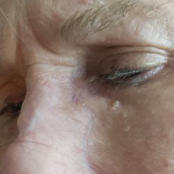 LVPG Plastic and Reconstructive Surgery - Very small scar for the amount of cancer surgery. It was deep and long. Thank you Dr Miles for the great job!