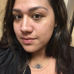 Carma Medspas - Post microdermabrasion treatment, wish I could've taken a before pic!