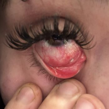 Miji Beauty eyelash - The white thing is the glue that is stuck in my eye - Eyelash Service Near Me - Van Nuys , California Miji Beauty eyelash - The white thing is the glue that is stuck in my eye - Eyelash Service Near Me - Van Nuys , California