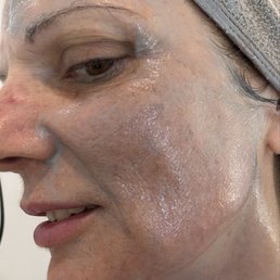 This is the  left side of my face with the mask applied