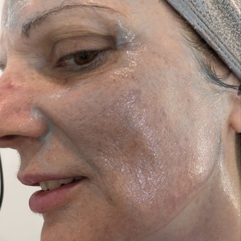 Aria Bio Spa - This is the left side of my face with the mask applied - Day Spas Near Me - Los Angeles, California Aria Bio Spa - This is the left side of my face with the mask applied - Day Spas Near Me - Los Angeles, California
