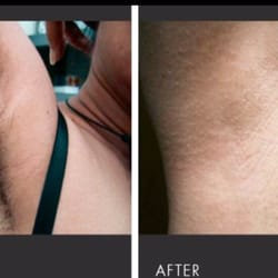 Sabaya Forever Salon - Before & After underarms