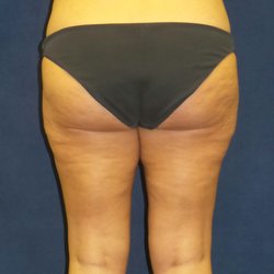Eric P Bachelor, MD, FACS - Female, 41 yr old AFTER LIPOSUCTION