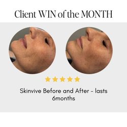 Le Monet Medspa - Skin boosters and more