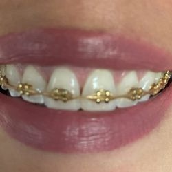 Pita Orthodontics - Lovin my GOLD braces!  Thanks Dr Pita!