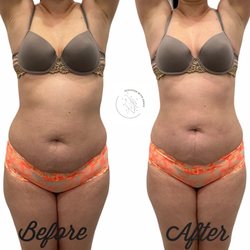 Sculpted with Grace - WOW! SUCH A DIFFERENCE.
PAINLESS AND NON INVASIVE METHOD OF BODY SCULPTING!