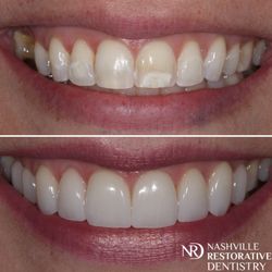 Nashville Restorative Dentistry - Check out this veneer case and others: https://www.nashvillerestorativedentistry.com/before-and-afters/
